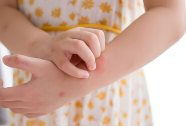 Managing Seasonal Allergies in Children