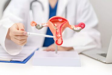 PCOS Causes, Symptoms and Treatment Options